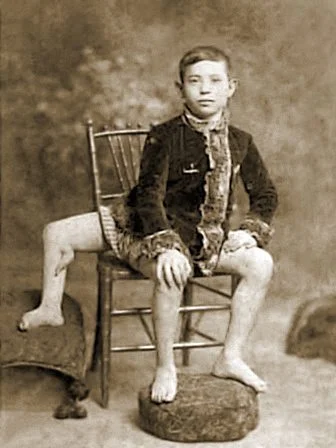 Francesco Lentini, l’Homme qui avait 3 jambes, 4 pieds et 2 pénis