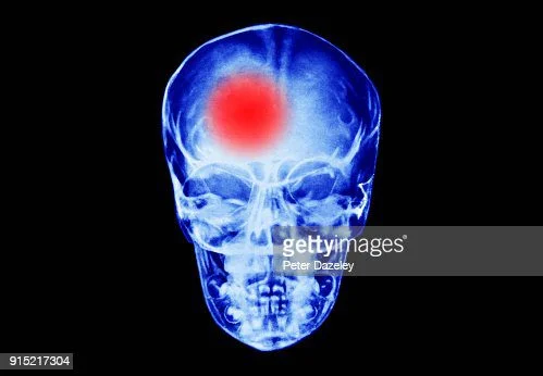  Comment éviter d’avoir un AVC